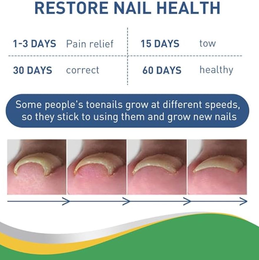 Toenail Correction Strips - 30 Pcs