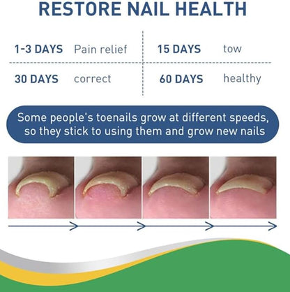Toenail Correction Strips - 30 Pcs