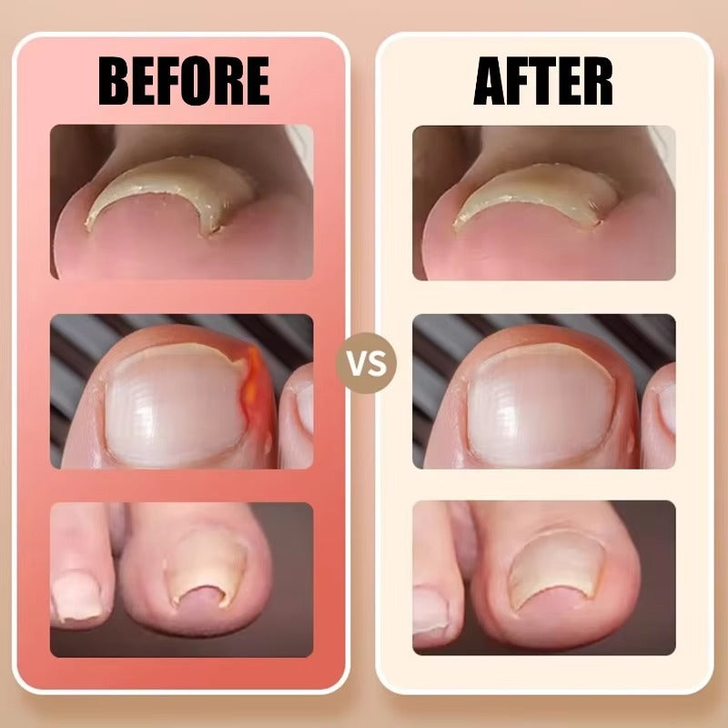 Toenail Correction Strips - 30 Pcs