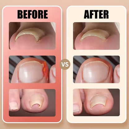 Toenail Correction Strips - 30 Pcs