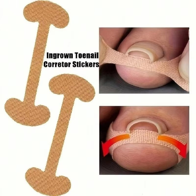 Toenail Correction Strips - 30 Pcs