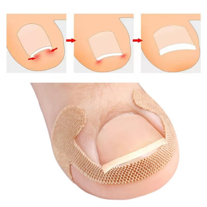 Toenail Correction Strips - 30 Pcs